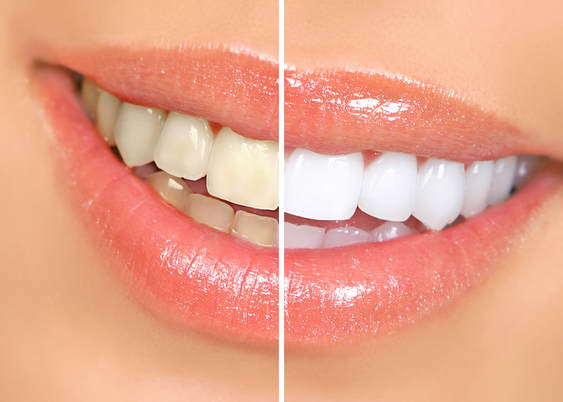 ZOOM Teeth Whitening at Cosmetic & Laser Center Medical Spa