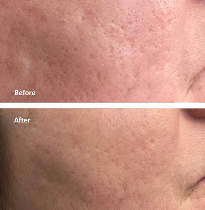 Laser Acne Scar Removal Boston and Woburn Before and After