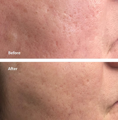 Laser Acne Scar Removal Medical Spa Before and After