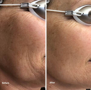 Medical Spa Skin Tightening Photofacial Holographic Facial Picoway Before and After