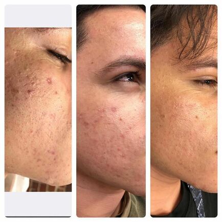 PRP Acne Scar Treatment Medical Spa Boston and Woburn Before and After