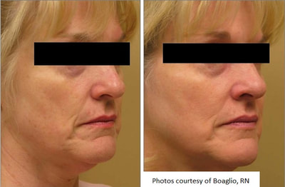 Skin Tightening and Rejuvenation Medical Spa Boston and Woburn Before and After