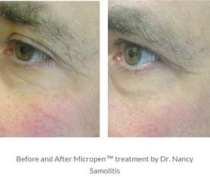 PRP Facelift Medical Spa Boston and Woburn Before and After