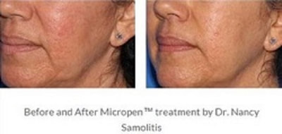 PRP Facelift Medical Spa Boston and Woburn Before and After