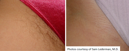 Laser Hair Removal Medical Spa Boston and Woburn Before and After