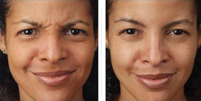 Botox Fillers No More Wrinkles Boston And Woburn Al Spa Before After