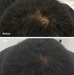 PRP Hair Restoration Medical Spa Before and After