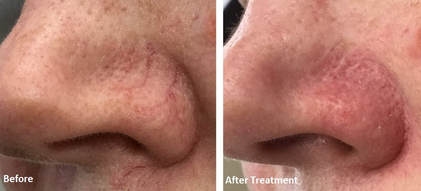 Laser Vascular Lesion Medical Spa Boston and Woburn Before and After