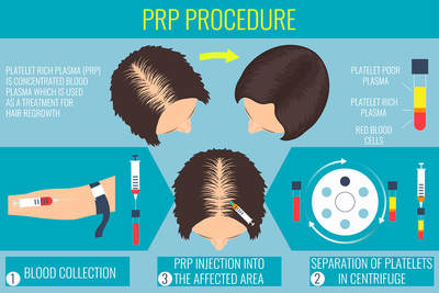 PRP Hair Restoration Medical Spa Boston and Woburn How PRP Works