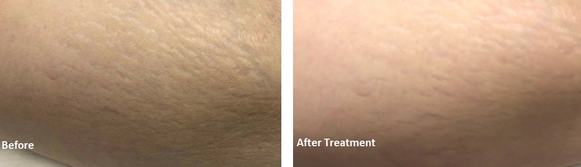 Stretch Marks Reduction Medical Spa Boston and Woburn Before and After