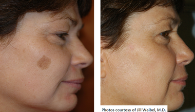 Skin Pigmentation Medical Spa Boston and Woburn Before and After