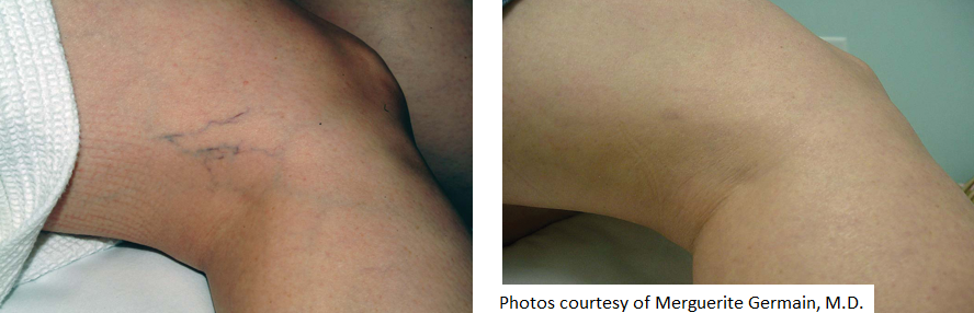 Laser Vascular Lesion Medical Spa Boston and Woburn Before and After